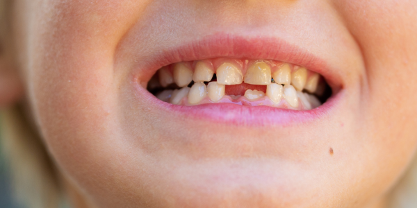 dentiste-spécialisé-enfants-Annecy Toutes les informations pour se préparer à un premier rendez-vous chez le dentiste avec son enfant.